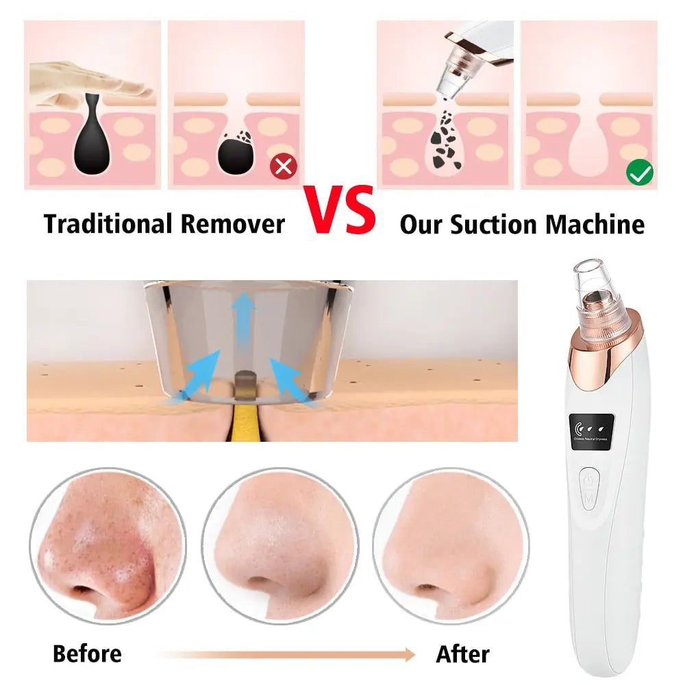 Vacuum Electric Blackhead Remover Cleaner - MyGadgets411